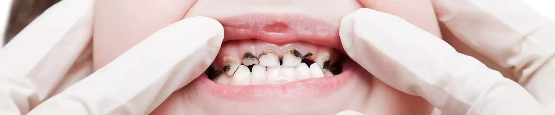 ما هي اسباب تسوس اسنان الاطفال ؟