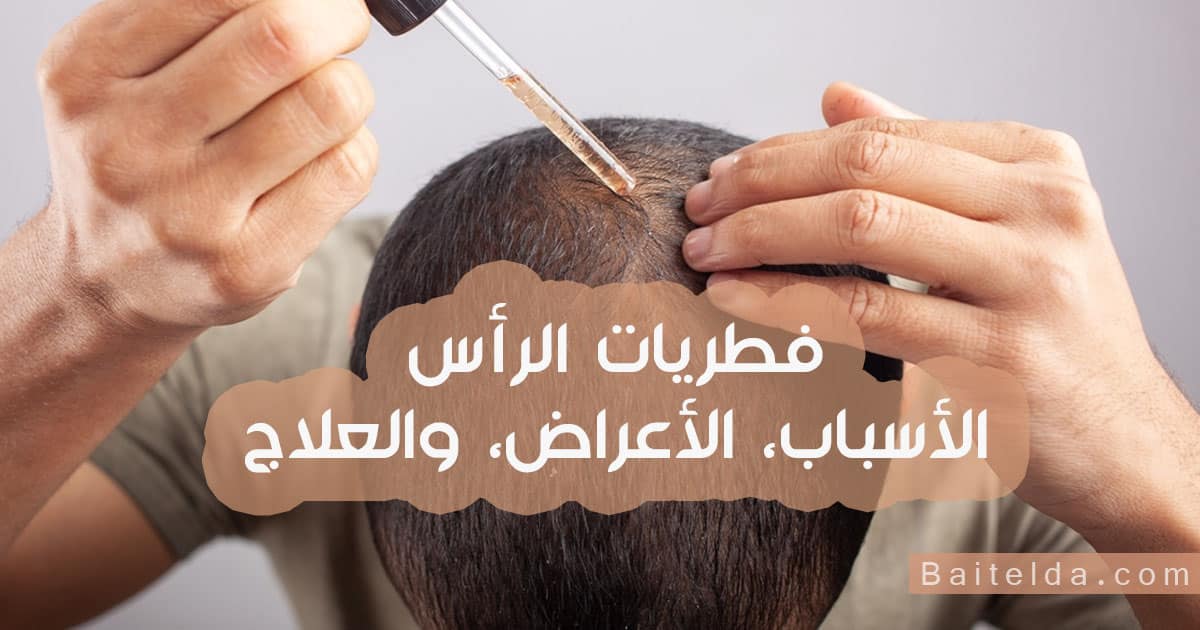 فطريات الرأس أسبابها وأعراضها وعلاجها مجلة اسأل طبيبك